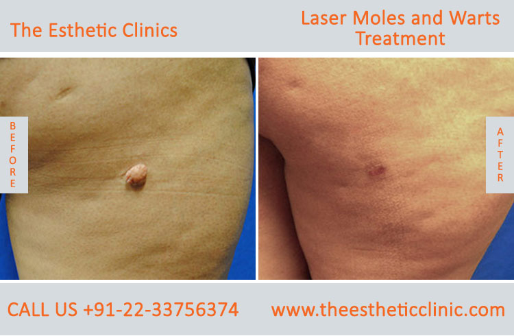 Moles Wart Skin Tags Laser Treatment before after photos in mumbai india (1)